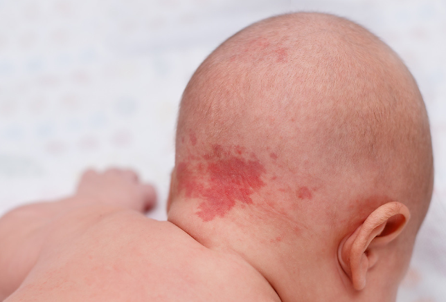 有胎记的孩子是什么投胎来的